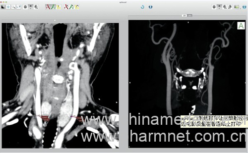 OsiriX PRO  