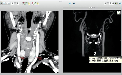 OsiriX PRO  